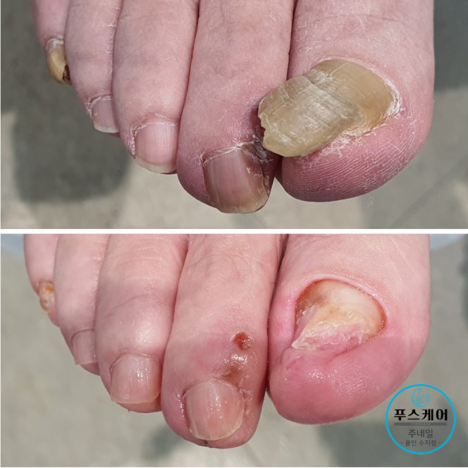 87세 엄마의 두꺼워진 변형무좀발톱을 보고 차마 집으로 가지 못한 딸/성남수원수지보정동백죽전동/주네일푸스케어용인수지점/무좀발톱염증파고드는내향성발톱손톱변형전문점 87세 엄마의 두꺼워진 변형무좀발톱을 보고 차마 집으로 가지 못한 딸/성남수원수지보정동백죽전동/주네일푸스케어용인수지점/무좀발톱염증파고드는내향성발톱손톱변형전문점