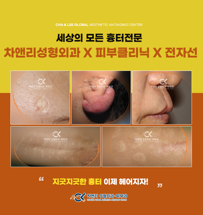  흉터제거성형외과피부과를 찾고 있다면