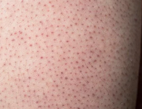  팔,다리,얼굴 모공각화증 케어 닭살피부 매끈하게 하는법