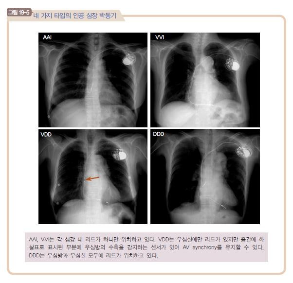 인공심박동기 pacemaker AAI, VVI, VDD, DDD : 네이버 블로그