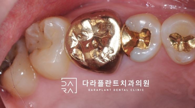 덕양구 사랑니 발치 신경에 가까운 매복치아 발치.고양시 치과 4