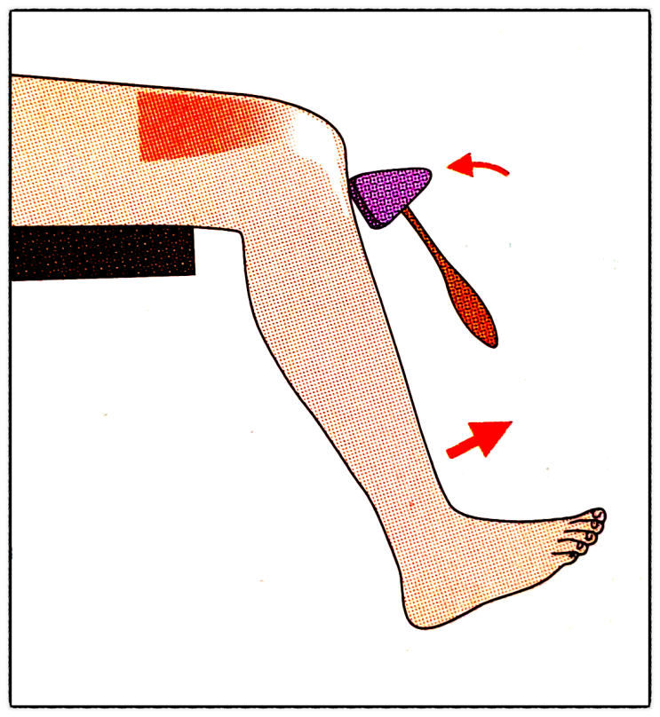 수정된 애쉬워스 척도(Modified Ashworth scale, MAS), 깊은힘줄반사(심부건반사, Deep tendon reflex, DTR)