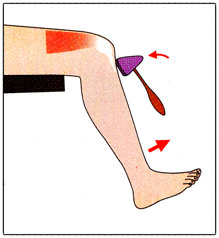  수정된 애쉬워스 척도(Modified Ashworth scale, MAS), 깊은힘줄반사(심부건반사, Deep tendon reflex, DTR)