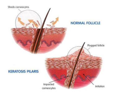 팔다리얼굴모공각화증케어 소름돋는피부 매끈하게만드는법 2