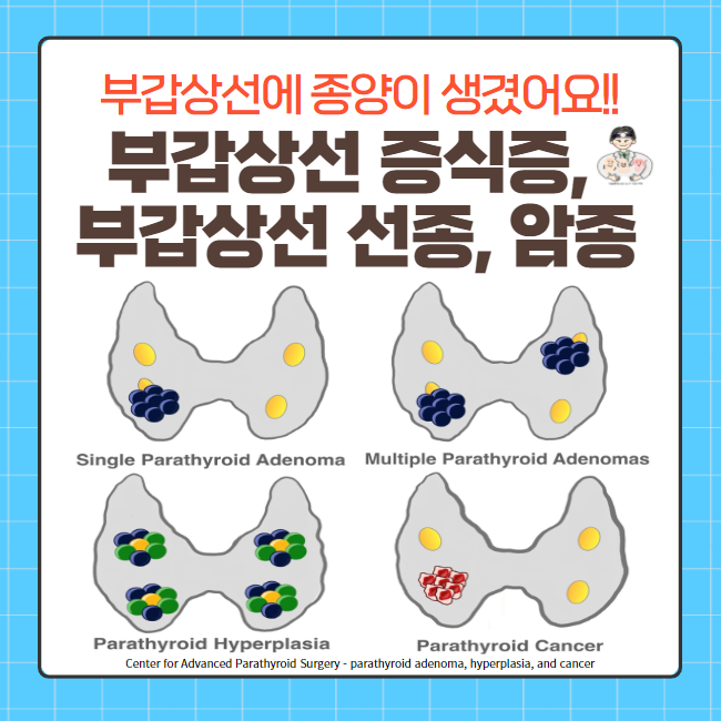  부갑상선(Parathyroid gland) 질환 (3) - 부갑상선 선종(adenoma), 부갑상선 암종(carcinoma), 부갑상선 증식증(hyperplasia)