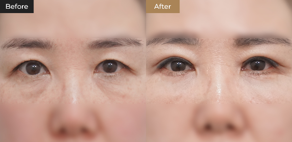 하안검 수술비용과 회복기간 10