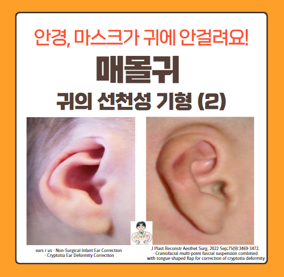  귀의 선천성 기형 (2) - 매몰귀(Cryptotia)
