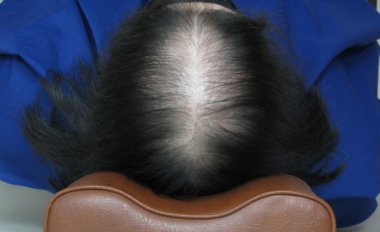  홍대탈모치료, 여성 안드로겐형 탈모와 다낭성 난소증후군(PCOS)