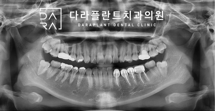 덕양구 사랑니 발치 신경에 가까운 매복치아 발치.고양시 치과 1