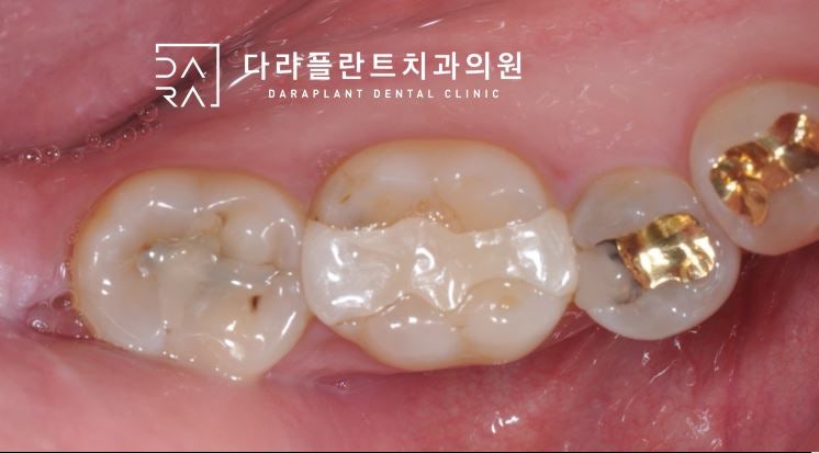 덕양구 사랑니 발치 신경에 가까운 매복치아 발치.고양시 치과 3