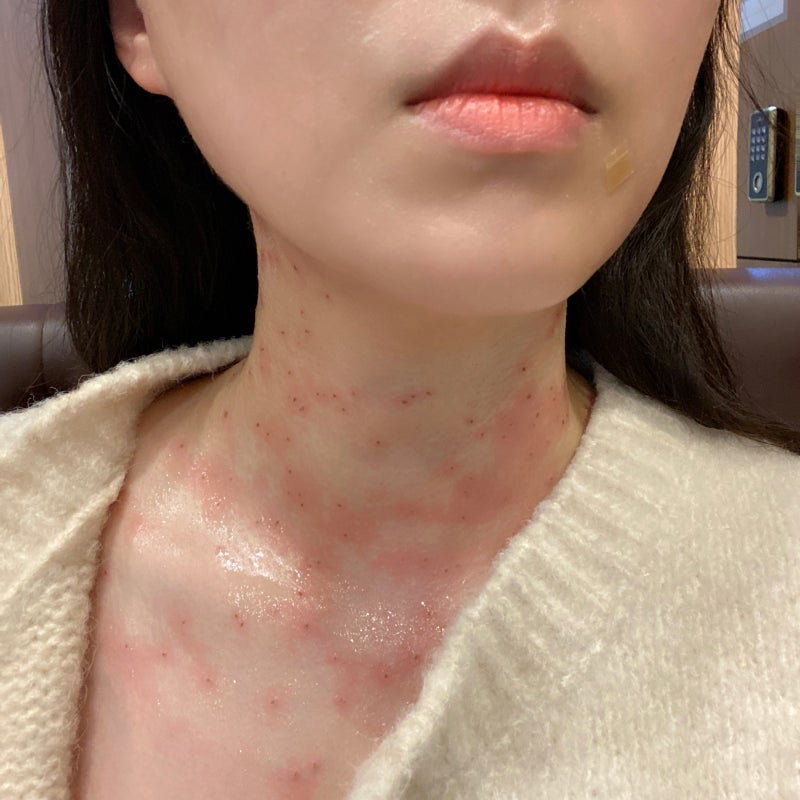 [목동사이렌의원] 내돈내산 점 비립종 사마귀 쥐젖 제거 후기 (개당 천원)