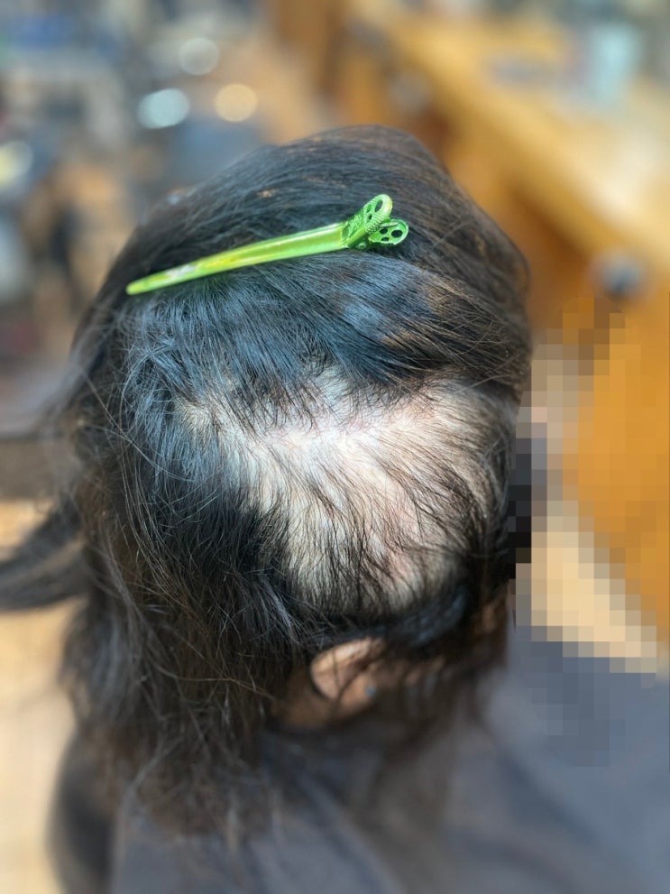  오늘도 역대급 탈모펌 여성탈모파마 이야기!