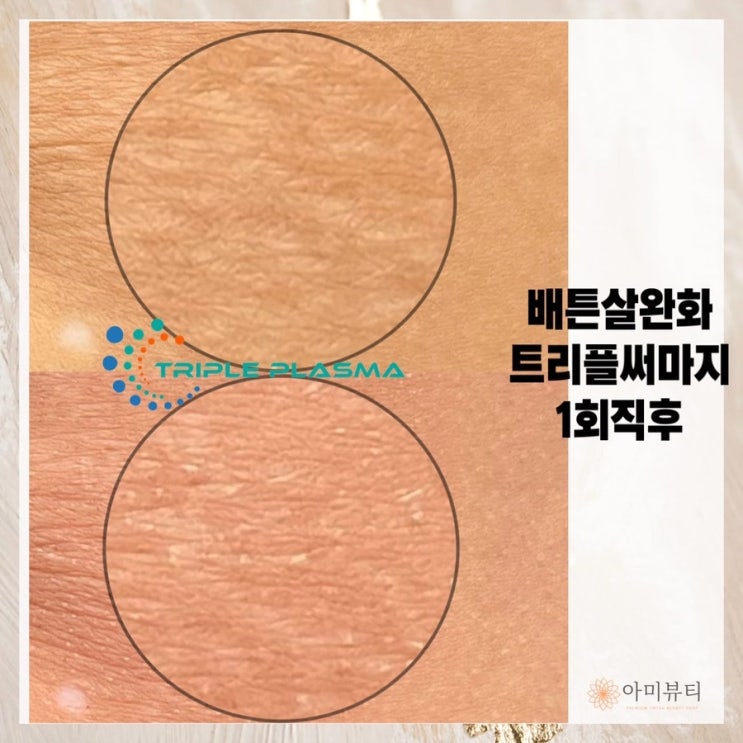 [대구 토탈뷰티 아미뷰티] 배튼살,켈로이드수술자국 고민이시면 트리플플라즈마로 해결하세요 