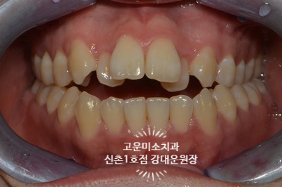  덧니 개방교합 돌출을 동반한 치료증례 신촌치과 고운미소 신촌1호점 증례입니다.ㅣ
