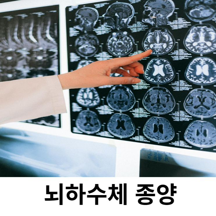  뇌하수체 종양 증상과 검사/ 수술을 꼭 해야 하나요?