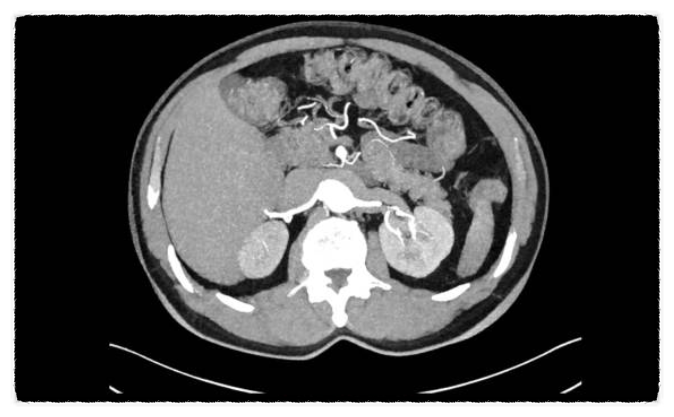 췌장암 검사 방법 및 비용 췌장 초음파 CT MRI, 췌장암 혈액검사 수치 종양표지자 검사 : 네이버 블로그
