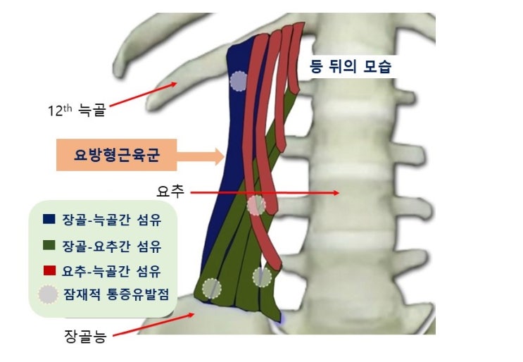 허리통증과 허리네모근(요방형근, Quadratus Lumborum)의 통증유발점(trigger point) 스트레칭