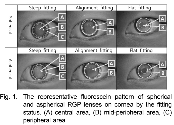 콘택트렌즈 하드/소프트 처방법 - 이론(임상x)+자동굴절력계(AR)결과지 읽는 법