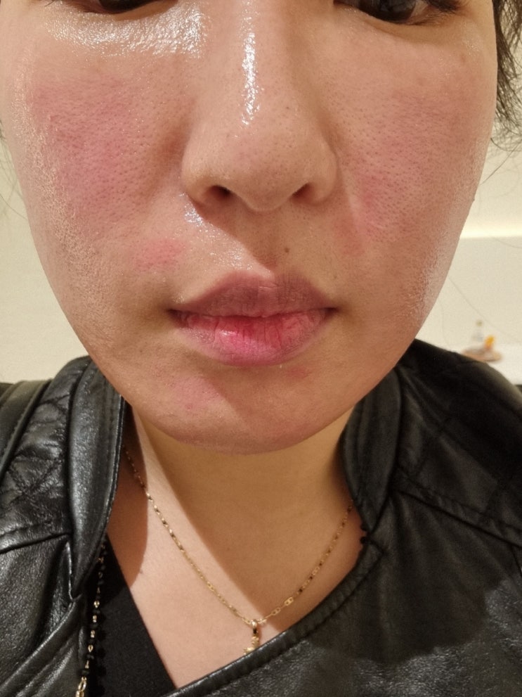  [튠페이스내돈내산찐후기] 효과,통증,주기/엘디엠물방울리프팅/호텔같은 청담피부과 리프팅관리끝판왕