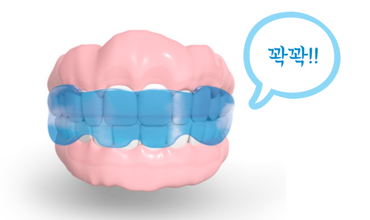 주의사항 6. 근기능장치(프리올소, EF line) 치료에 대한 소개 및 주의사항/ 하남 교정주치의 연세꿈꾸는치과 주의사항 6. 근기능장치(프리올소, EF line) 치료에 대한 소개 및 주의사항/ 하남 교정주치의 연세꿈꾸는치과
