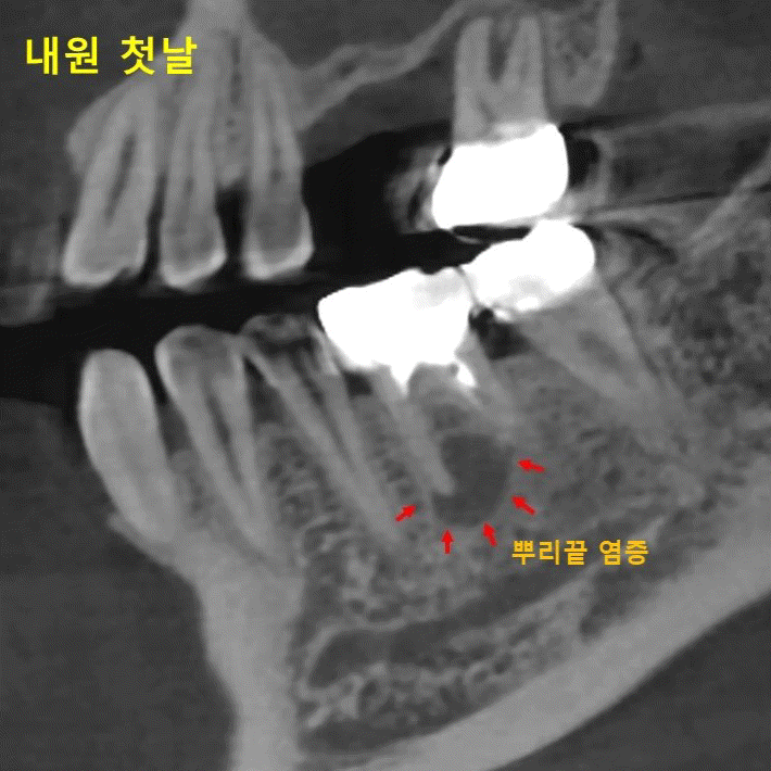  재 신경치료와 치유 과정 / 신경치료 통증 줄이는 방법은?
