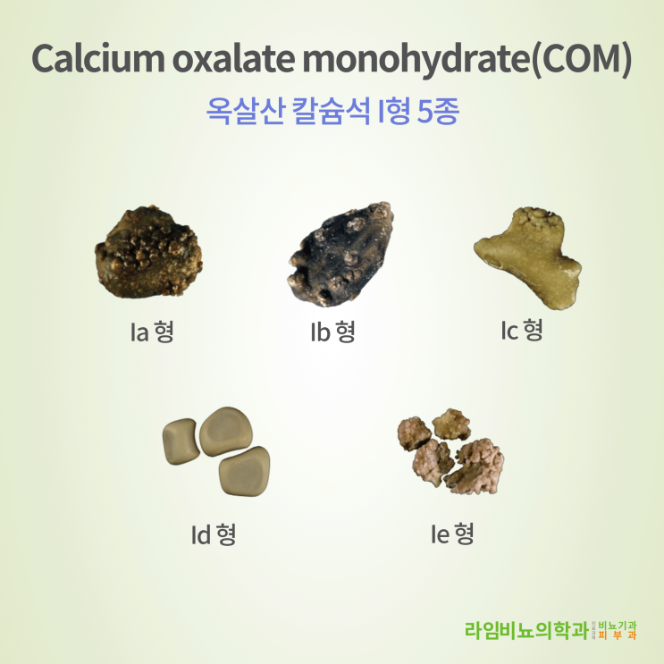  요로결석 시리즈 - 두 번째, 결석의 종류는 왜 이리 많을까요? COM- Ia형 칼슘석