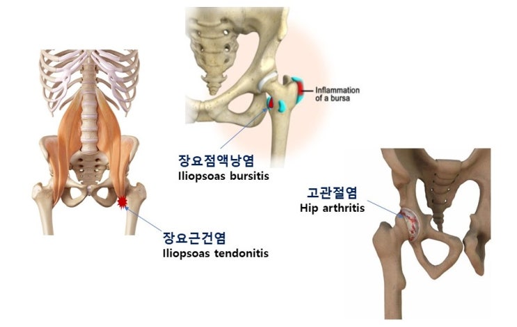 장요근(엉덩허리근, Iliopsoas m.)과 허리통증과의 관련, 그리고 스트레칭