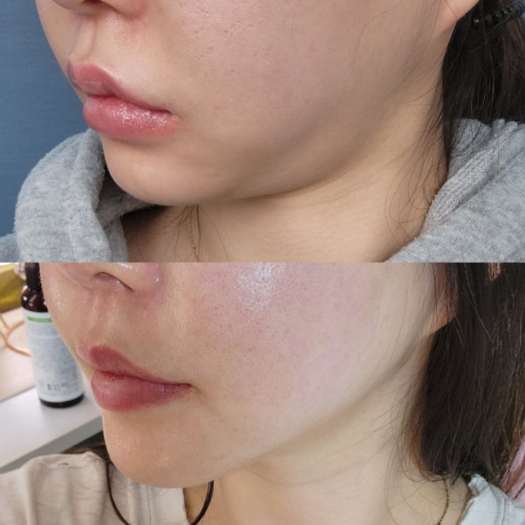  강남역피부과 울쎄라 300샷 당일 다음날 2주후기