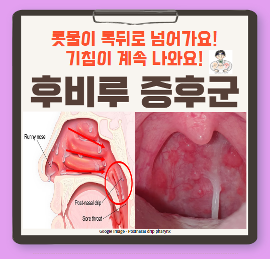  후비루 증후군(Postnasal drip syndrome, PND syndrome) - 콧물이 목뒤로 넘어가요, 기침이 계속 나와요