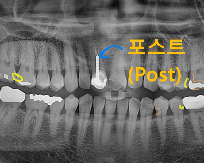 하남 신장동치과 치아 기둥이라는 포스트(Post)에 대해 알아봅시다