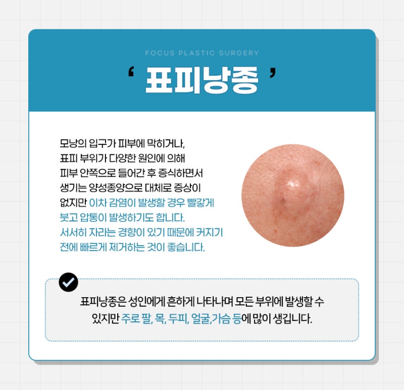 부천표피낭종 피부과 숙련도 높은 노하우로 흉터를 최소화하세요 : 네이버 블로그
