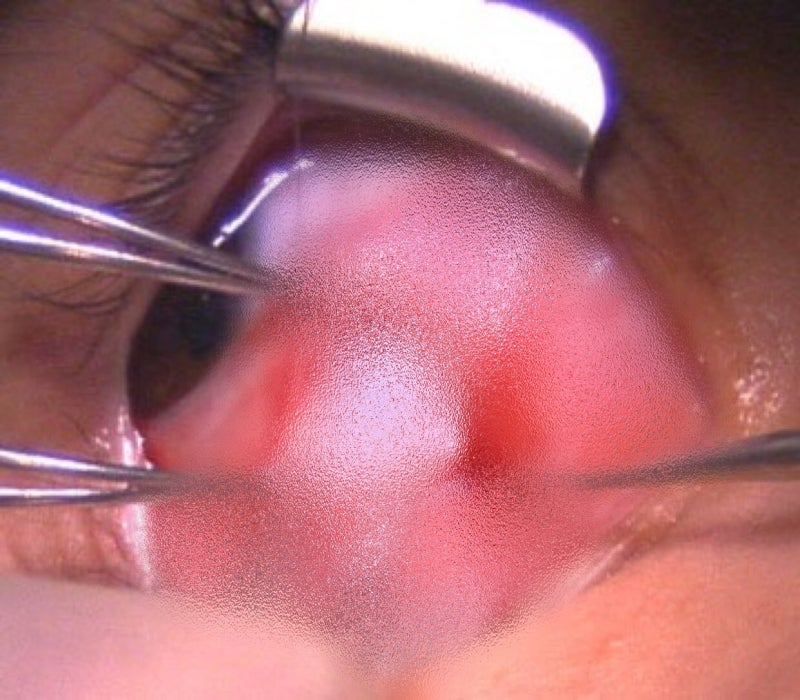 수술도 안되고 안경으로도 교정이 되지 수술도 안되고 안경으로도 교정이 되지