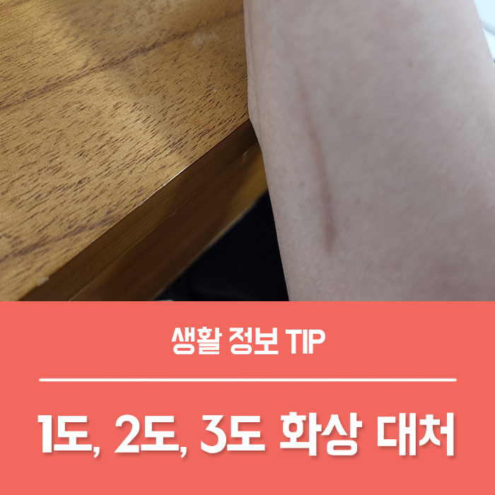  1도 2도 3도 화상, 햇빛 일광 화상(표재성 심재성) 연고