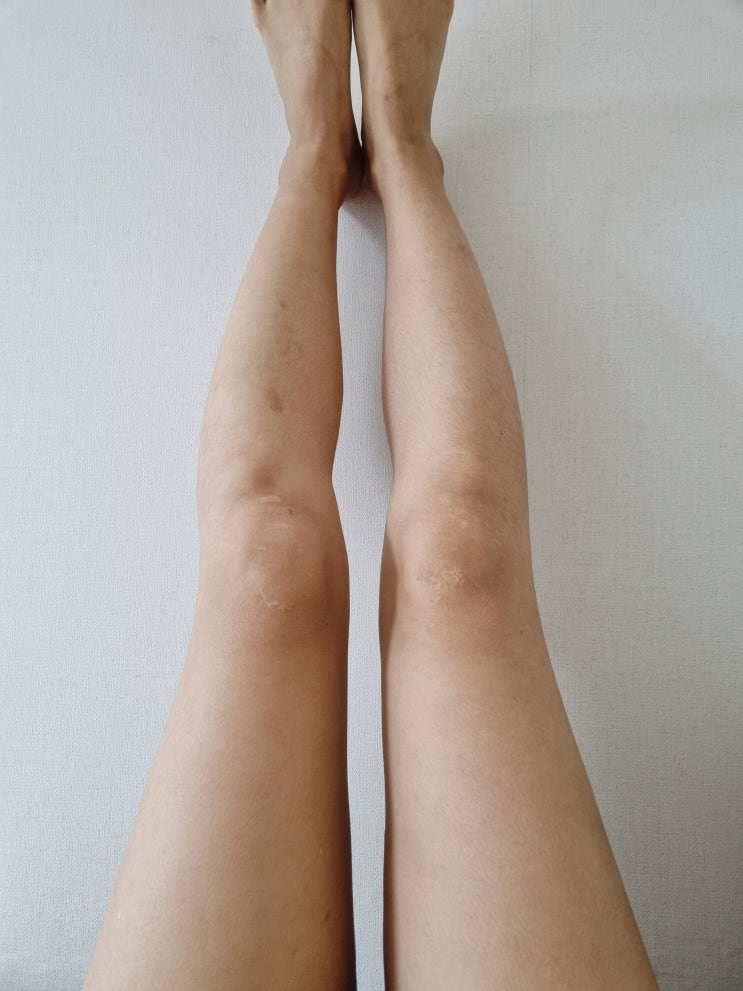  부천에서 허벅지 무한람스 시술 2개월 후기 포스팅