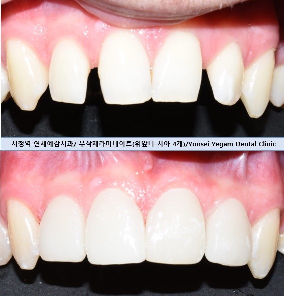 [서울역/치과]삐뚤고 벌어진 치아 무삭제라미네이트 케이스