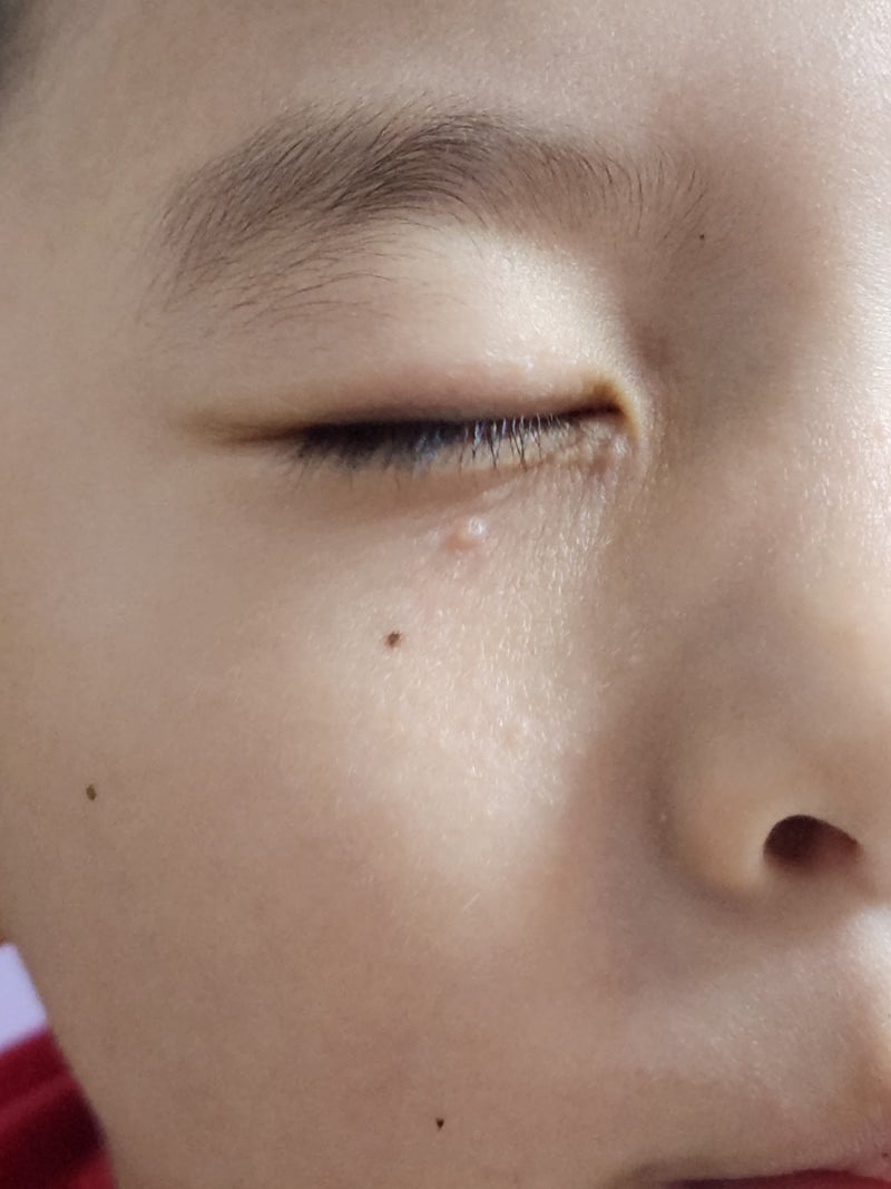 아기 5세유아 물사마귀 없애는법 피부과에서 제거했어요