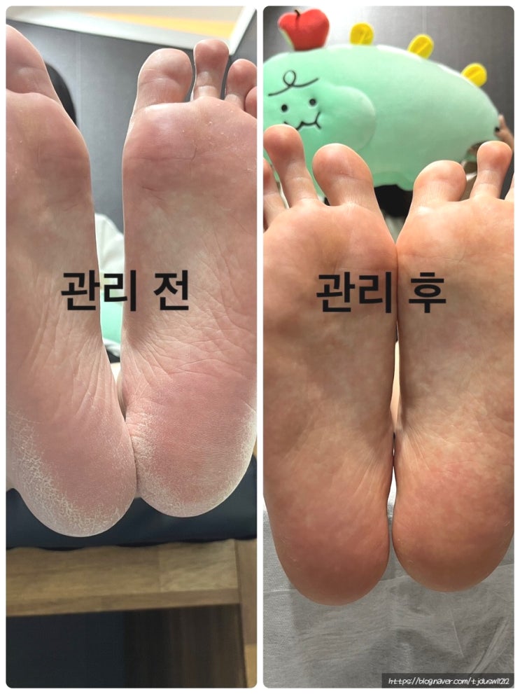  [서면발각질] 매끄러운발 원한다면? 야무진뷰티샵에서 발각질관리 추천