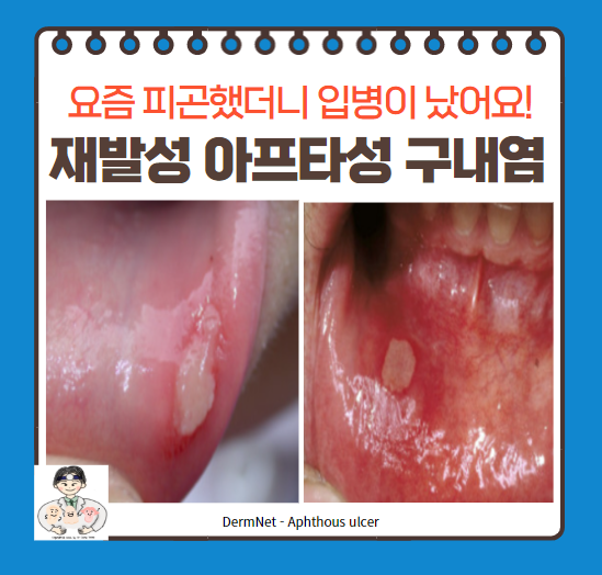  재발성 아프타성 구내염(recurrent aphthous stomatitis) - 요즘 피곤했더니 입병이 났어요!