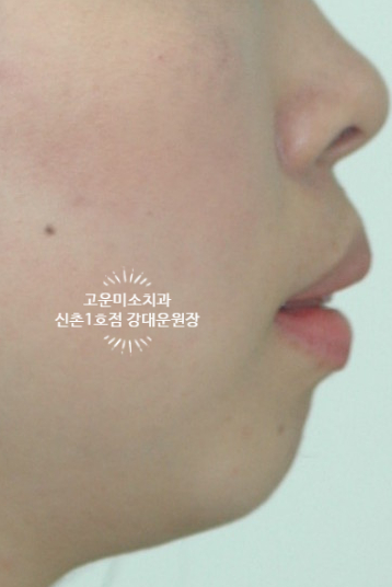  돌출 거미스마일 2급부정교합 개방교합 무턱을 동반한 신촌교정치과 고운미소신촌1호점 증례입니다.
