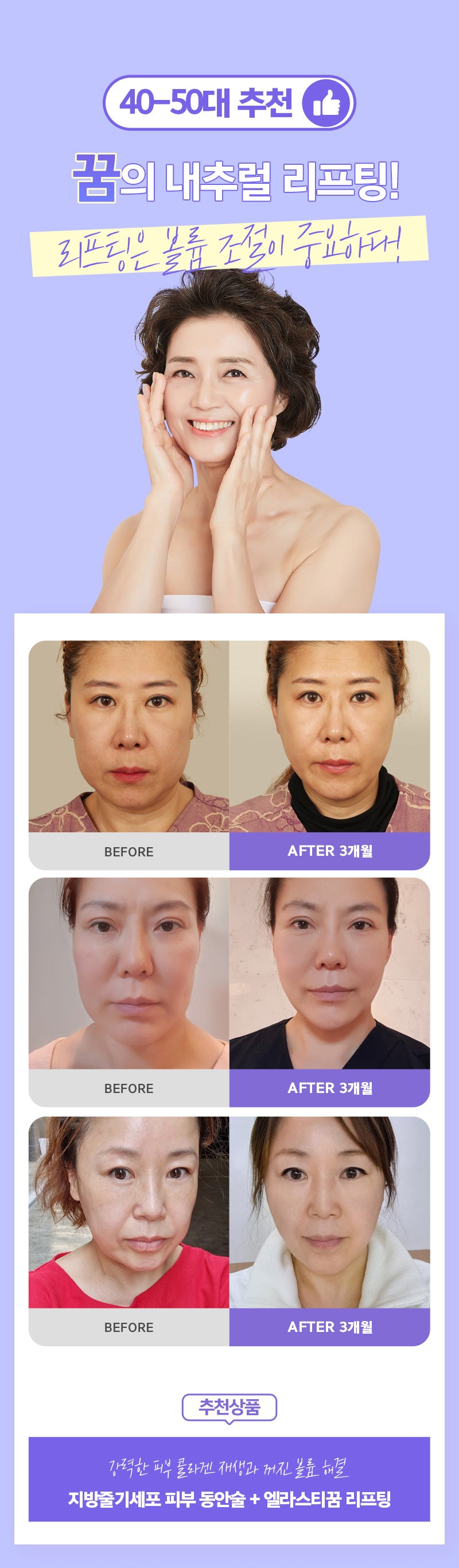 40대부터 꼭 필요한 리프팅시술, 4
