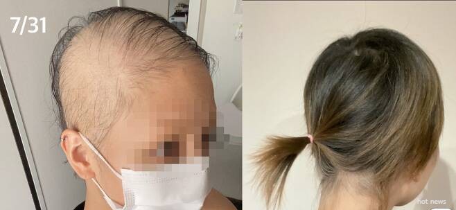 日 여성 코로나 백신 맞고 대머리 된 1년 후 머리카락 자란 모습