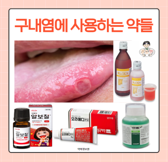  구내염에 사용하는 약들 - 알보칠 / 오라메디 / 헥사메딘 가글 / 탄툼 가글