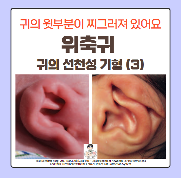  귀의 선천성 기형 (3) - 위축귀(Constricted ear) = 배상귀(Cup ear) = 토이(Lop ear)