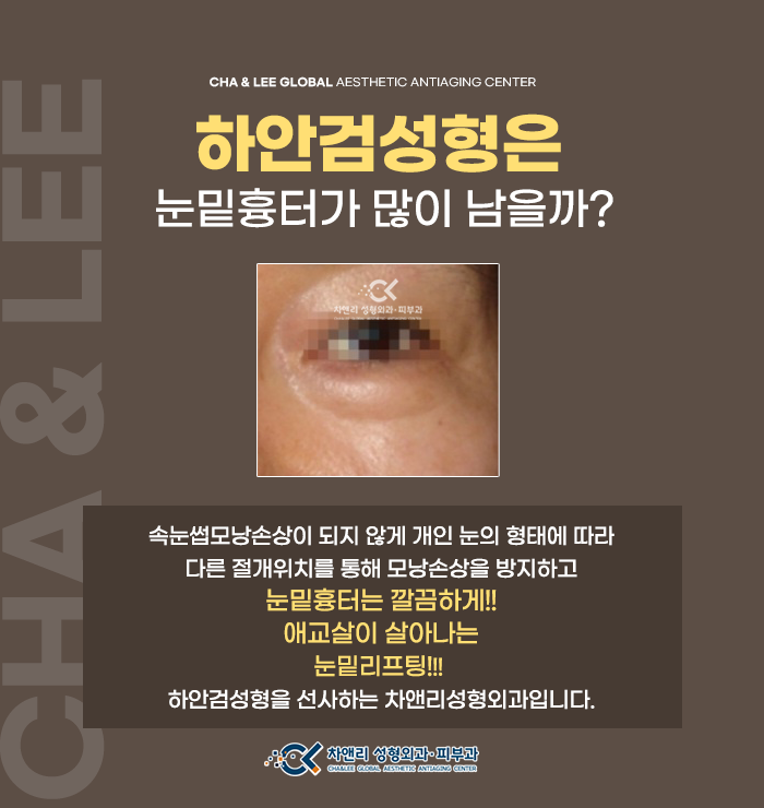  일산하안검성형 눈밑리프팅후 눈밑흉터 걱정된다면