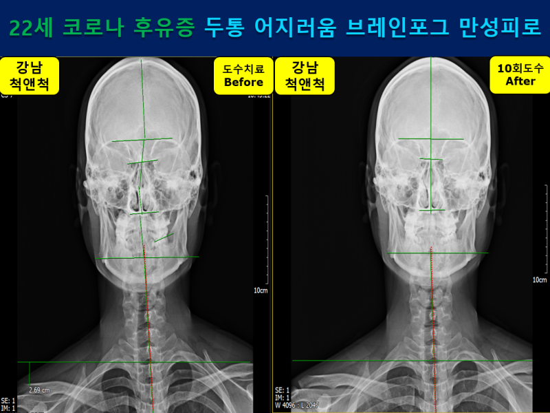 (강남역) 두통, 브레인 포그, 현기증, 운동실조 등 새로운 크라운의 후유증은 하악 관절(뇌신경) + 척추 도수치료가 필요합니다.