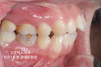  교정재발 개방교합 비발치윗니돌출 거미스마일 동반한 교정치료증례 신촌교정치과 고운미소치과 신촌1호점 치료증례입니다.