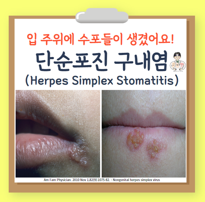  단순포진 구내염(herpes simplex stomatitis) - 입 주위에 수포들이 생겼어요!