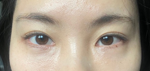  눈밑지방이식, 눈밑지방재배치 3개월 후기