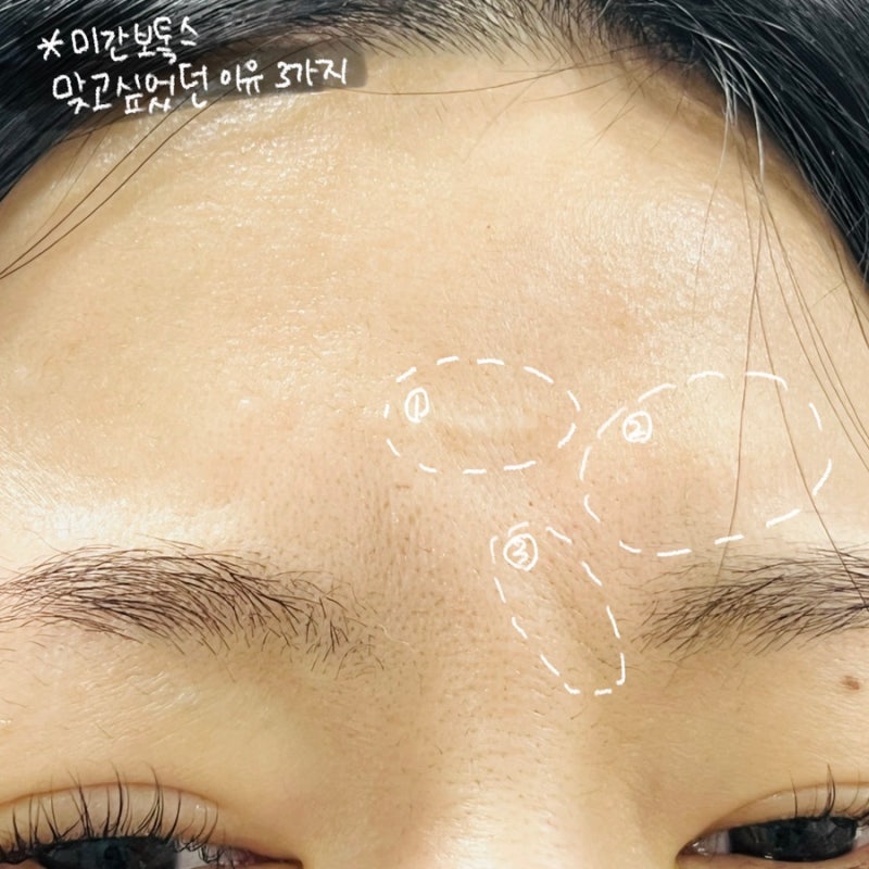 미간 보톡스 후기부터 부작용까지 꾸준히 맞아보면서 느낀 주의할점 : 네이버 블로그