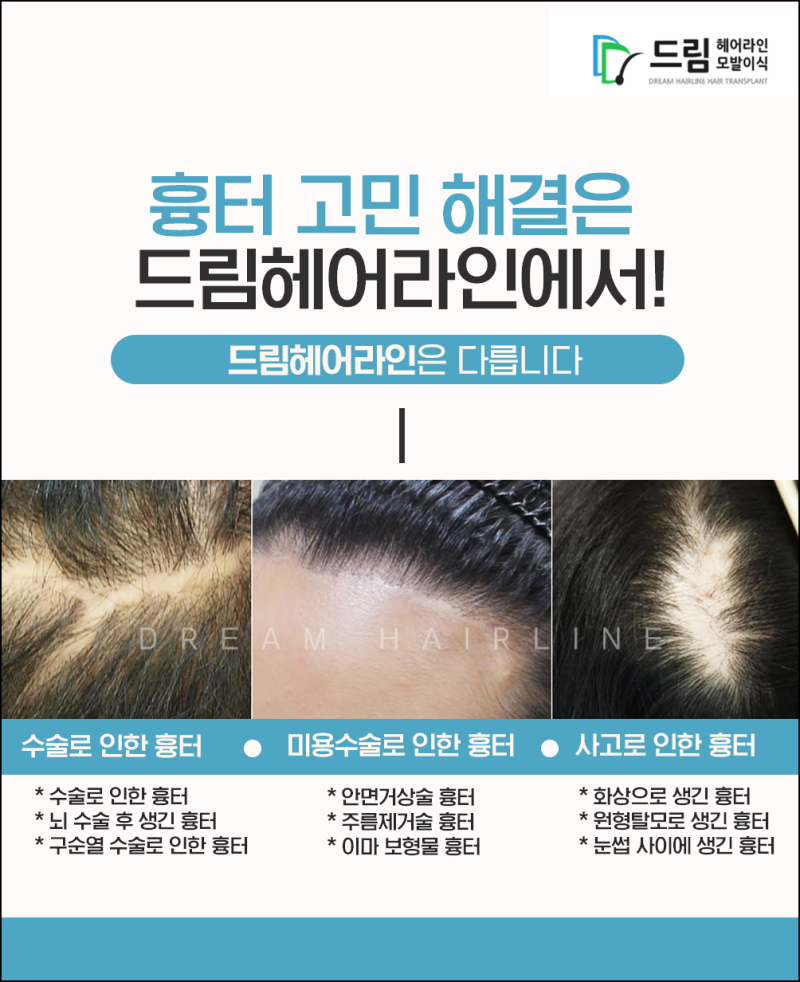 드림헤어라인 압구정안면거상술 부작용을 경험한다면